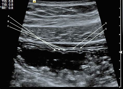 Figure 1 From The Use Of Ultrasound In The Diagnosis Of Crohn S