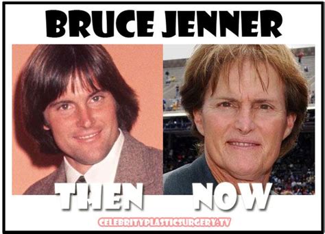 Bruce Jenner Celebrity Plastic Surgery Celebrity Surgery Bruce Jenner