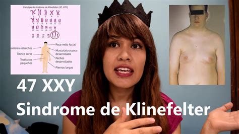 Sindrome De Klinefelter Trisomia 47 Xxy Youtube