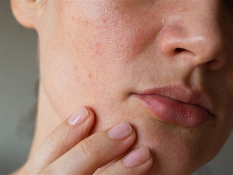Acne On Cheeks 2023 Why Youre Breaking Out And How To Treat It