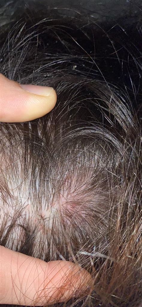Red Blotches And Sores On My Scalp Rmedicaladvice