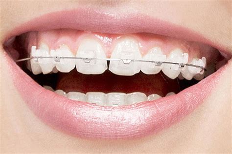 3 Reasons To Consider Clear Braces Southlake Dental Care Middleburg