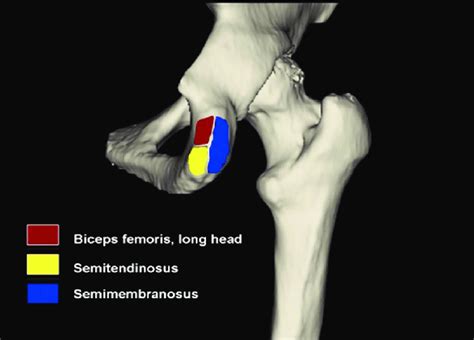 Insertion Of Hamstring Tendons On The Ischial Tuberosity Download