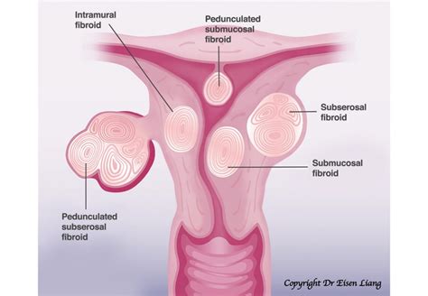 Uterine Fibroid Embolisation And Other Fibroid Treatments Sydney