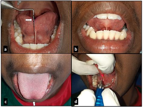 Cureus Laser Assisted Frenectomy Followed By Post Operative Tongue Exercises In Ankyloglossia