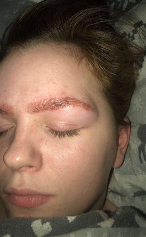 Girl Burns Eyebrows With Dyeing Kits And Warns Of The Importance Of Patch Tests Metro News