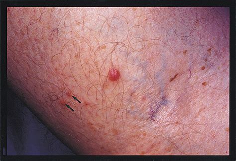 Multiple Asymptomatic Papules In The Popliteal Fossa Dermatology