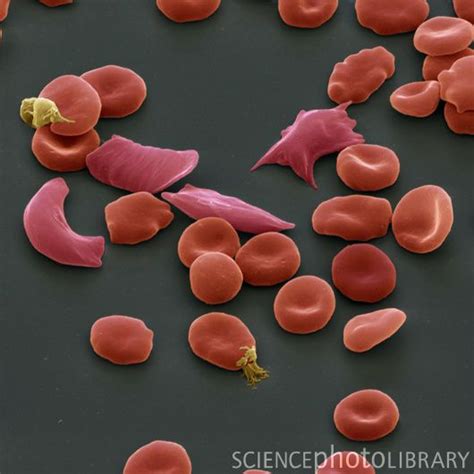 Sickle Cell Anemia Under Microscope Quinton Oyler