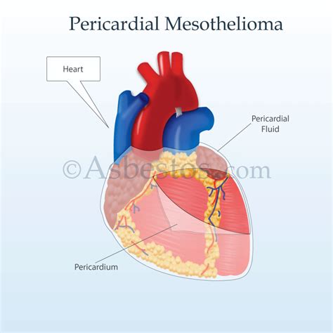 Pericardial Mesothelioma Overview Of Malignant Heart Cancer