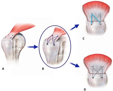 [pdf] Arthroscopic Single Row Versus Double Row Repair For Full Thickness Posterosuperior