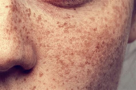 06 Freckles Whats The Difference Between Melasma Sun Spots And Other