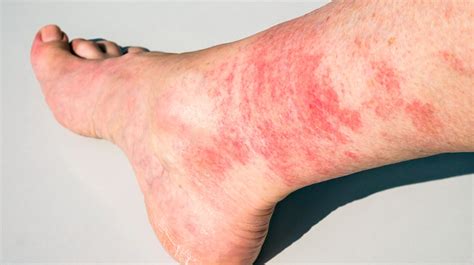 Red Blotches On Legs After Exercise Exercise