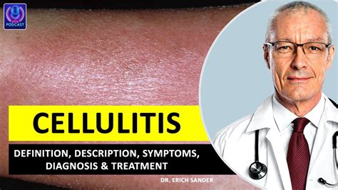 Cellulitis Definition Description Causes And Symptoms Diagnosis And Treatment Of Cellulitis