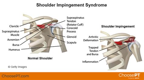 Why Does My Shoulder Hurt Specialty Orthopaedics
