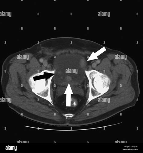 Bladder Cancer Ct Scan Black And White Stock Photos And Images Alamy