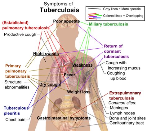 Diagnostic Challenges In Latent Tuberculosis Infection A Brief Review