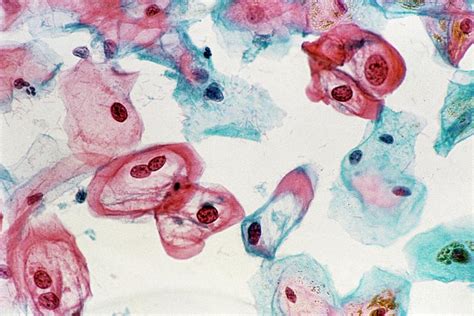 Lm Of Cervical Smear Revealing Hpv Infection Photograph By Science