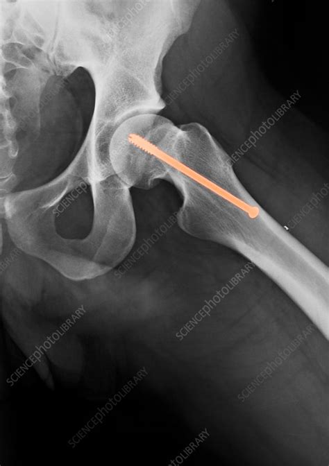 Pin In Hip X Ray Stock Image C0272673 Science Photo Library