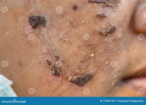 Backgrounds Of Lesions Skin Caused By Acne On The Face Stock
