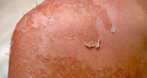 Causes Of Peeling Skin What Causes Skin To Peel