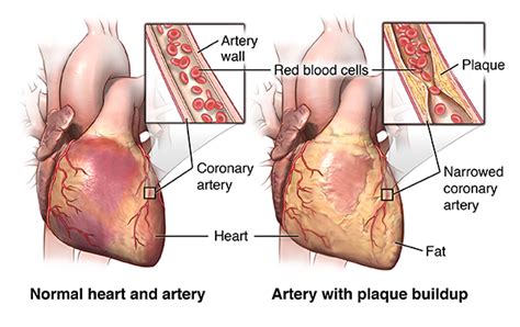 Coronary Artery Bypass Graft Surgery Johns Hopkins Medicine