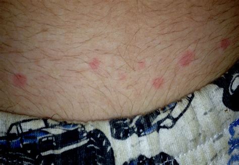 What Do Bed Bugs Bites Look Like Pictures Of Bed Bug