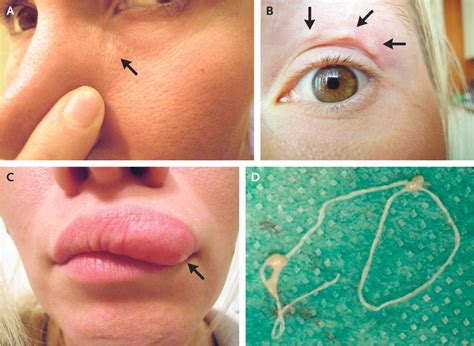 Lump On Womans Face Turns Out To Be A Parasite Crawling Under Her Skin