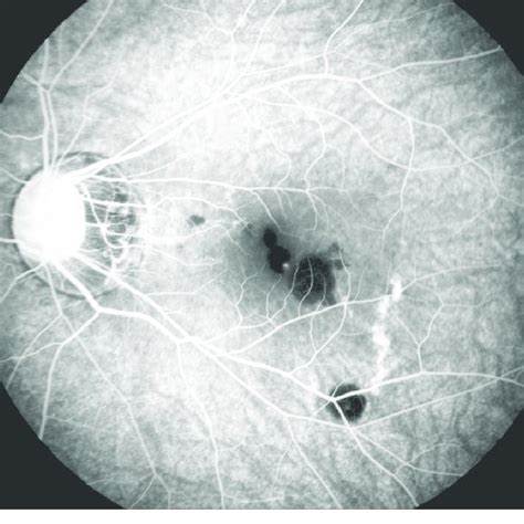 Myopic Fundus With Subretinal Haemorrhages At The Fovea And Along The