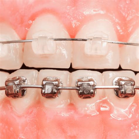 Clear Ceramic Braces For A More ‘invisible Look From Ely Smiles
