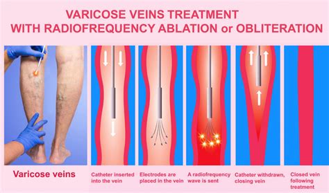 Radiofrequency Ablation For Varicose Veins Elite Vein Clinic