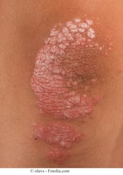 Cure per la psoriasi e rimedi naturali