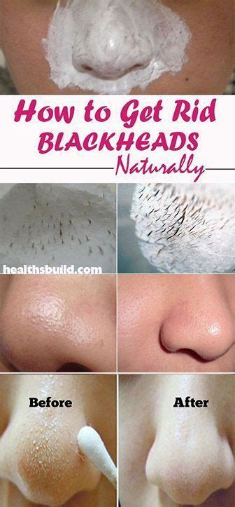 Blackhead Remover Best Natural Ways To Remove Acne For Good Health