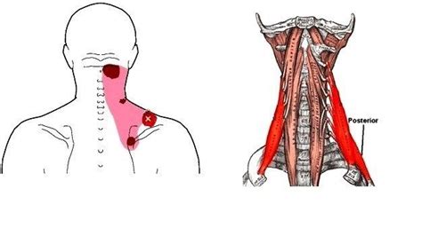 The Posterior Neck Muscle Location And Trigger Points Trigger Points