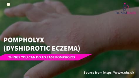 Pompholyx Dyshidrotic Eczema Dyshidrotic Eczema Treatment Youtube