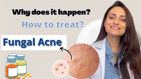 Fungal Acne Why Does It Happen How To Treat Dermatologist Dr