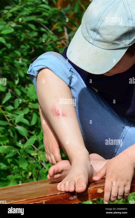 Closeup Of Injured Young Kids Knee After He Fell Down On Pavement The