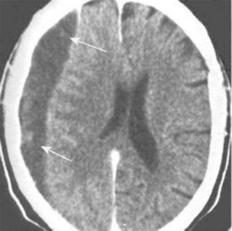 Figure 1 From Current Diagnosis And Treatment Of Chronic Subdural