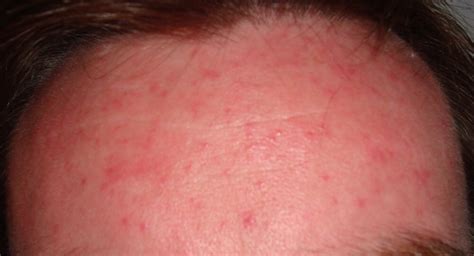 Learn How To Treat Acne Rosacea And Key Differences To Acne