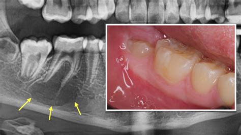 2 Traumati Simple Bone Cyst 10 Year Old Jaw Bone Mandible Kazemi Oral