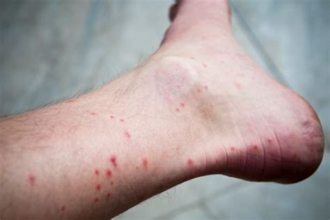 How To Remove Dark Spots On Legs From Mosquito Bites