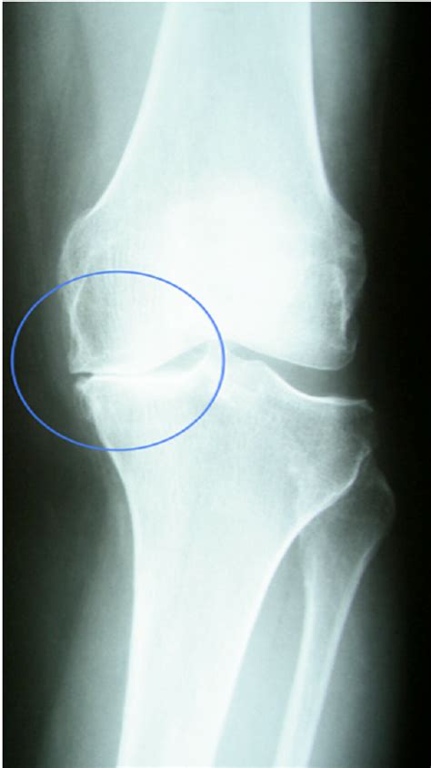 Radiography Of The Knee With Medial Osteoarthrosis And Varus Deformity