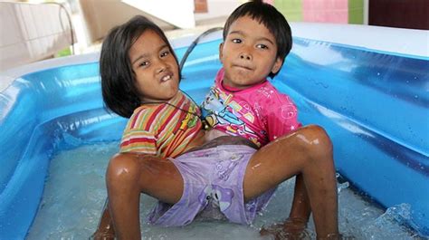 The Inspiring Story Of Conjoined Twins Who Wants To Stay Together
