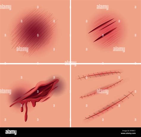 Set Of Open Wound Illustration Stock Vector Image And Art Alamy