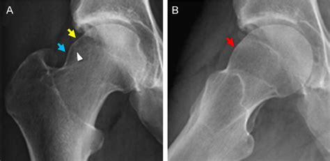 Cam Type Femoral Acetabular Impingement Syndrome 38 Year Old Man With