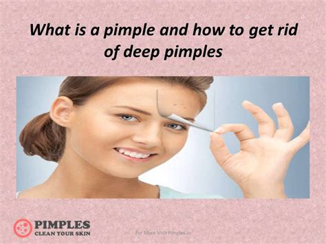 How To Get Rid Of Deep Pimples Fast Youtube