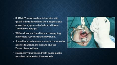 Adenoidectomy And Tonsillectomy Ppt Video Online Download