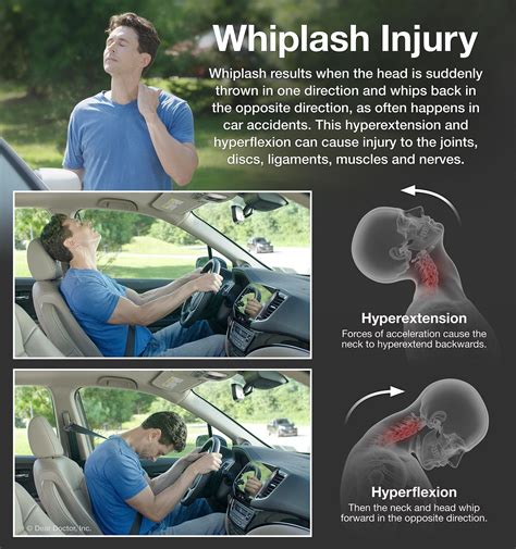 Whiplash Chiropractor In St Augustine Fl Derek Sisak Dc