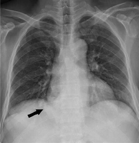 Chest Pa Radiograph Shows An Abnormal Right Paraspinal Soft Tissue