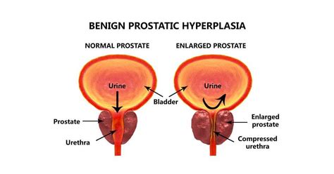 Benign Prostatic Hyperplasia BPH Men S Clinic Dr Tan Partners