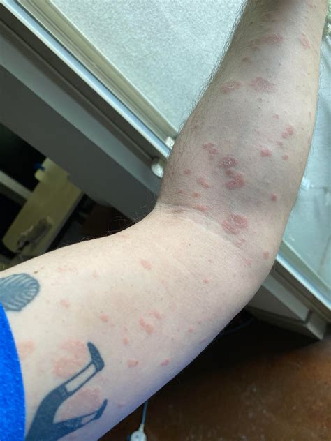 Is This A Case Of Pityriasis Rosea Started After A Crazy Flu